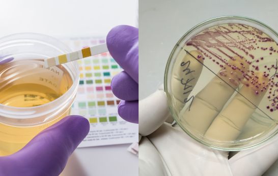 Urinkontrolle im Vergleich zur Harnkultur